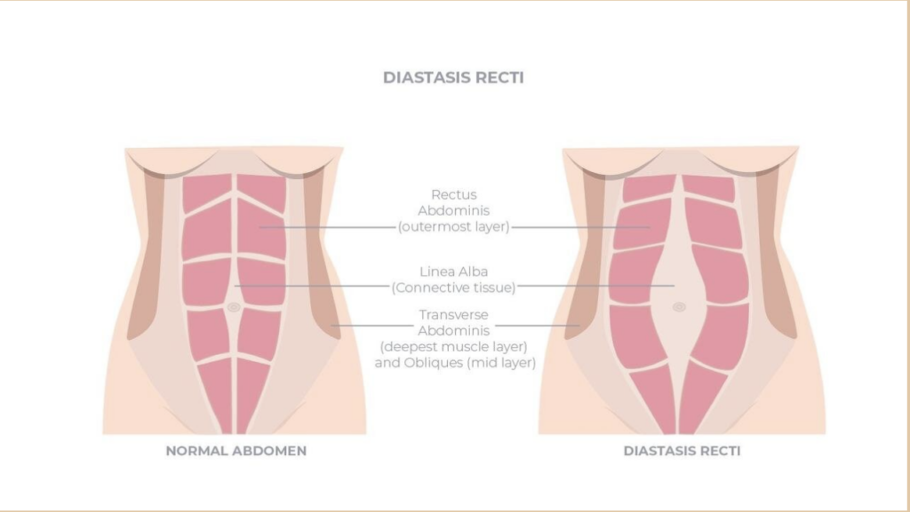 What is a diastasis 